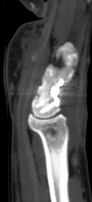 Figure 4 for case surgical carpal fusion ( RID2240 )